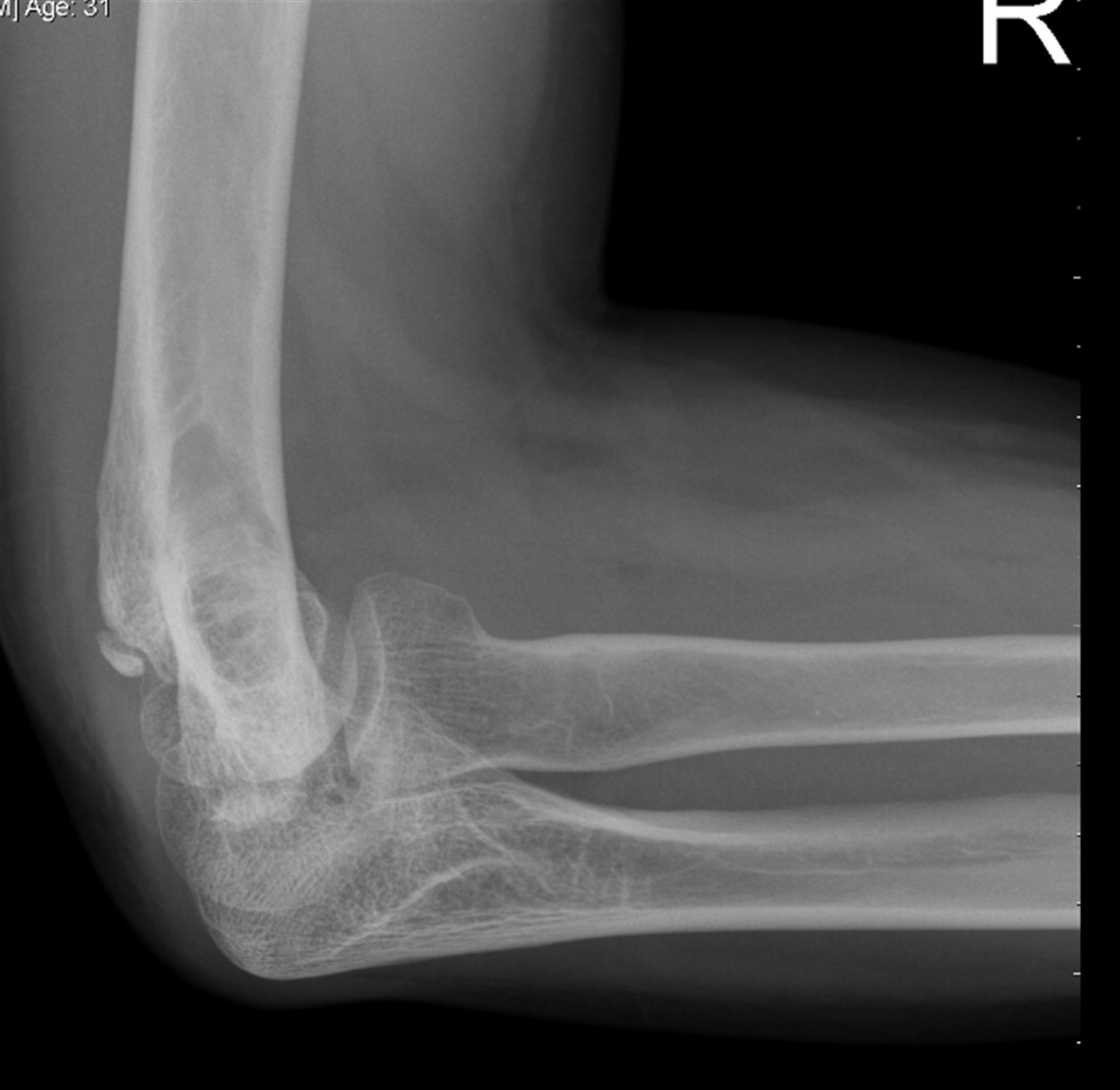 Cubital Tunnel Syndrome Hand Orthobullets